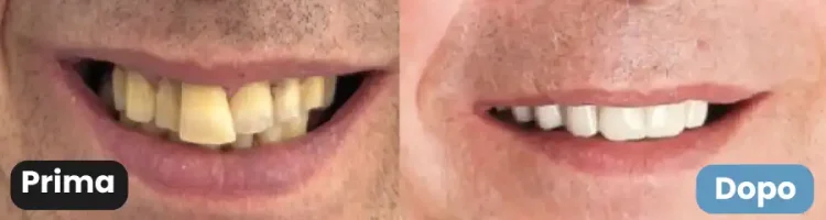 all on 4 doppia arcata