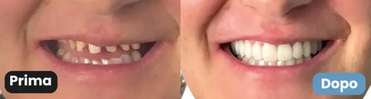 con innesto osseo prima dopo