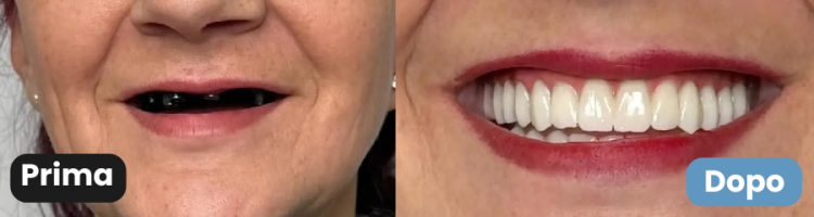 con rigenerazione ossea