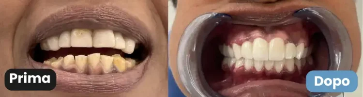 corone in zirconio prima dopo