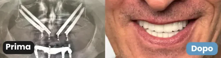 impianti zigomatici prima dopo