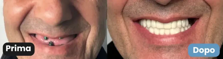 riabilitazione doppia arcata 8 impianti prima dopo